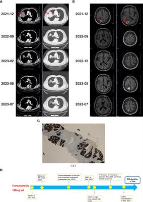 EGFR kinase domain duplication in lung adenocarcinoma with systemic and intracranial response to a double-dose of furmonertinib: a case report and literature review